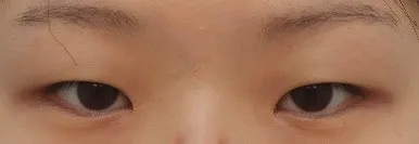 韓國雙眼皮手術：切開法與縫合法的比較，3位真實案例術後對照