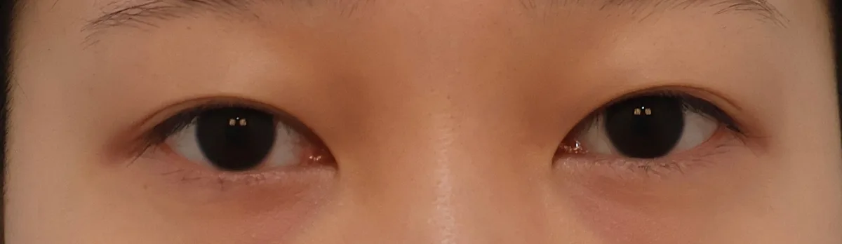 韓國上眼瞼去脂：3位真實患者的非切開手術成果