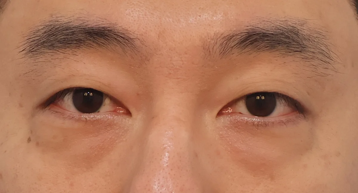 韓國淚溝脂肪移位：來自江南同一家診所的4位真實患者術後結果
