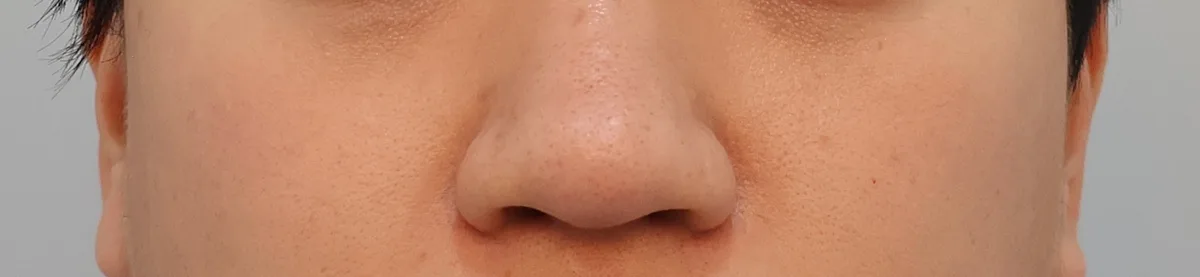 韓國縮鼻翼手術：鼻翼縮小手術實際的樣子（真實照片）