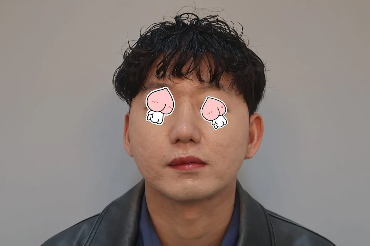 韓國鼻頭整形：不做全鼻整形，單獨鼻尖整形的真實術後樣貌