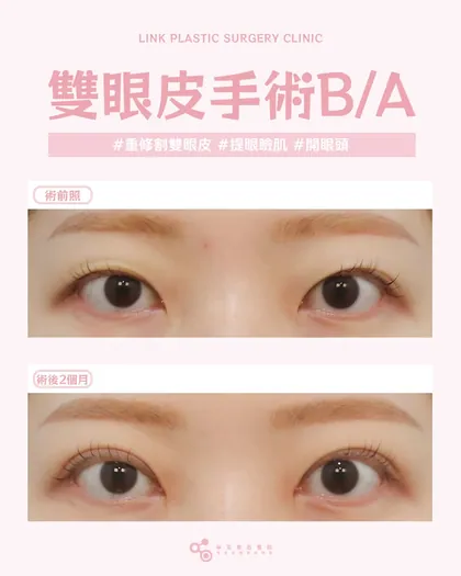 林克整形醫院 | 雙眼皮術後真實案例分享 ✨🧡手術項目: 重修割雙眼皮+提眼瞼肌+開眼頭🧡重修，是把