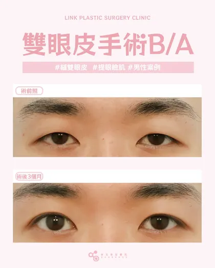 林克整形醫院 | 雙眼皮術後真實案例分享 ✨🤎手術項目: 縫雙眼皮+提眼瞼肌🤎男生有男生的眼型需求，