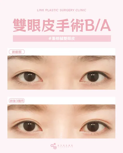 林克整形醫院 | 雙眼皮術後真實案例分享 ✨🧡手術項目: 重修縫雙眼皮🧡精准評估＋高超修復技術讓重修