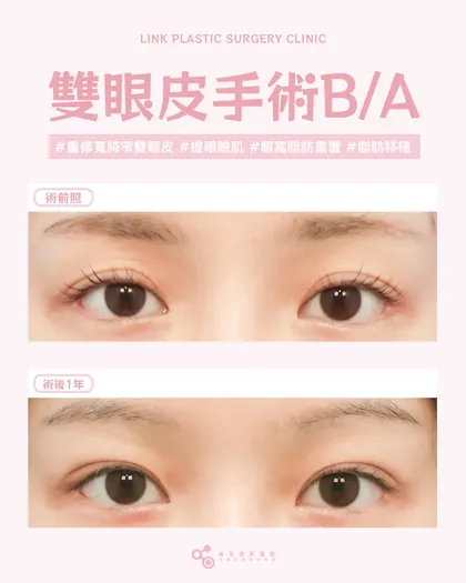 林克整形醫院 | 雙眼皮術後真實案例分享 ✨🧡手術項目: 重修寬降窄割雙眼皮+提眼瞼肌+眼窩脂肪重置