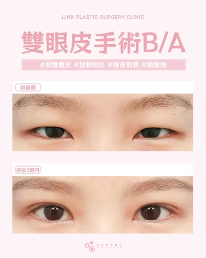 林克整形醫院 | 雙眼皮術後真實案例分享 ✨💜手術項目: 割雙眼皮+提眼瞼肌+眼皮取脂+開眼頭💜根據