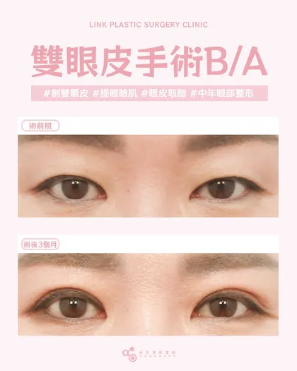 林克整形醫院 | 雙眼皮術後真實案例分享 ✨💜中年眼部整形💜手術項目: 割雙眼皮+提眼瞼肌+眼皮取脂