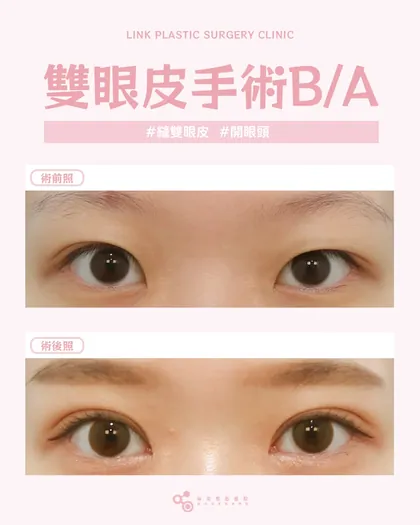 林克整形醫院 | 雙眼皮術後真實案例分享 ✨💙手術項目: 縫雙眼皮+開眼頭💙雙眼皮手術不只分「華麗」