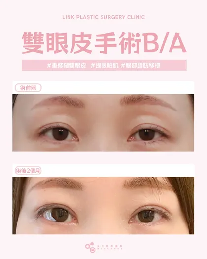 林克整形醫院 | 雙眼皮術後真實案例分享 ✨🧡手術項目: 重修縫雙眼皮+提眼瞼肌+眼皮脂肪移植🧡每一
