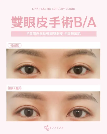 林克整形醫院 | 雙眼皮術後真實案例分享 ✨🧡手術項目: 重修縫雙眼皮+提眼瞼肌🧡不求誇張，但求剛剛