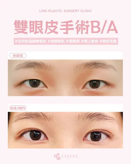 林克整形醫院 | 雙眼皮術後真實案例分享 ✨💙手術項目: 縫雙眼皮+提眼瞼肌+開眼頭+眼皮取脂+眼底