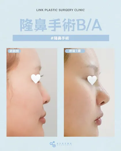 林克整形醫院 | 隆鼻術後真實案例分享 ✨🩵手術項目: 隆鼻初次手術🩵自然高挺，不假、不硬、不突兀根