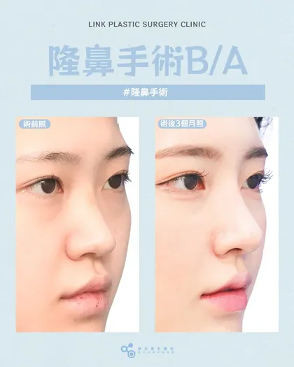 林克整形醫院 | 隆鼻術後真實案例分享 ✨🩵手術項目: 隆鼻初次手術🩵｜鼻型決定顏值｜立體度交給我們