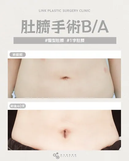 林克整形醫院 | 肚臍術後真實案例分享 ✨🤍手術項目: 肚臍手術🤍微調肚臍形狀整體比例立刻變好腹部看