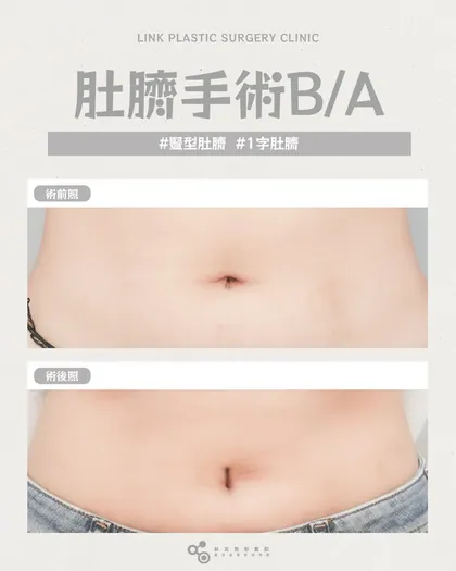 林克整形醫院 | 肚臍術後真實案例分享 ✨🤍手術項目: 肚臍手術🤍肚臍手術後：腹部拍照自由度100%