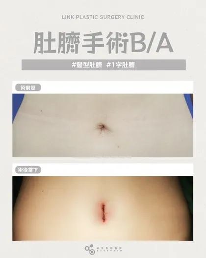 林克整形醫院 | 肚臍術後真實案例分享 ✨🤍手術項目: 肚臍手術🤍肚臍手術｜細節做到位比例才好看每個