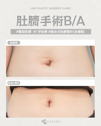 林克整形醫院 | 肚臍術後真實案例分享 ✨🤍手術項目: 肚臍手術🤍變形的肚臍，也能重新變好看形狀不對