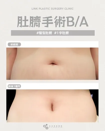 林克整形醫院 | 肚臍術後真實案例分享 ✨🤍手術項目: 肚臍手術🤍變形肚臍改善｜改善鬆垮、對稱度、深