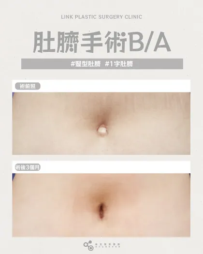 林克整形醫院 | 肚臍術後真實案例分享 ✨🤍手術項目: 肚臍手術🤍當肚臍變形影響你的自信就是該改善的