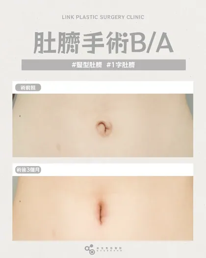 林克整形醫院 | 肚臍術後真實案例分享 ✨🤍手術項目: 肚臍手術🤍變形的肚臍，不一定只能接受外翻、扁