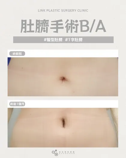 林克整形醫院 | 肚臍術後真實案例分享 ✨🤍手術項目: 肚臍手術🤍差別不只在肚臍，是整個腹部比例前後