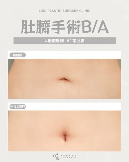 林克整形醫院 | 肚臍術後真實案例分享 ✨🤍手術項目: 肚臍手術🤍肚臍形狀影響整個腹部視覺修復後，腹