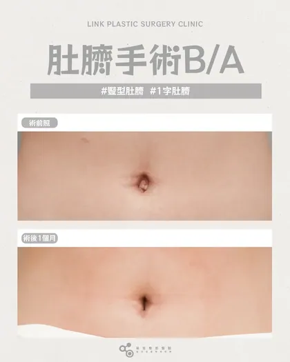 林克整形醫院 | 肚臍術後真實案例分享 ✨🤍手術項目: 肚臍手術🤍不需要誇張，只需要剛剛好肚臍整形的