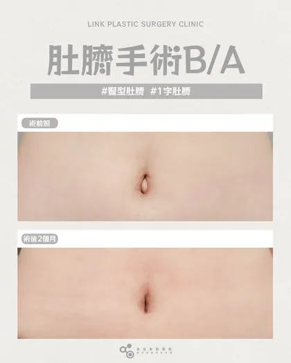 林克整形醫院 | 肚臍術後真實案例分享 ✨🤍手術項目: 肚臍手術🤍變形肚臍也能重新設計依照腹部線條，