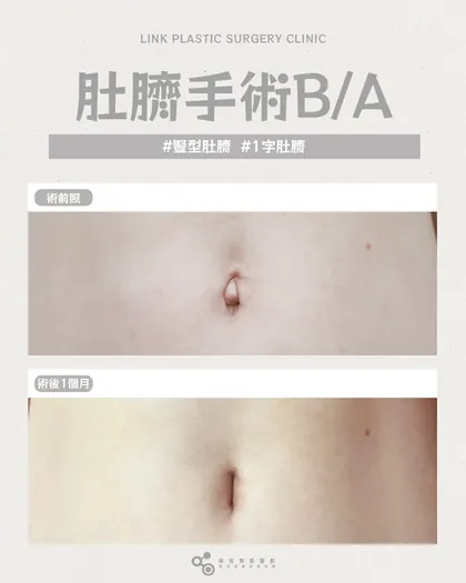 林克整形醫院 | 肚臍術後真實案例分享 ✨🤍手術項目: 肚臍手術🤍你不喜歡的肚臍形狀，是可以被改變的