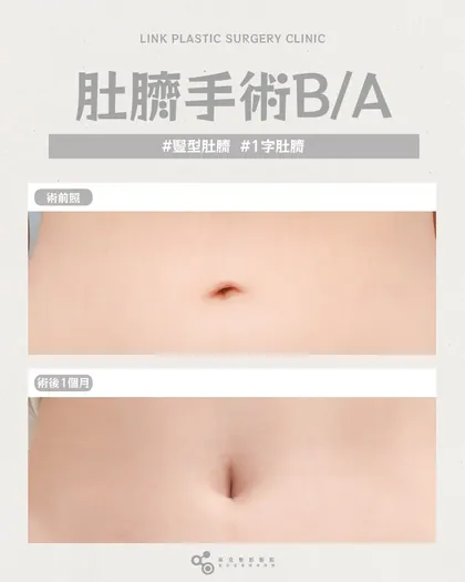 林克整形醫院 | 肚臍術後真實案例分享 ✨🤍手術項目: 肚臍手術🤍肚臍形狀影響整個腹部視覺修復後，腹