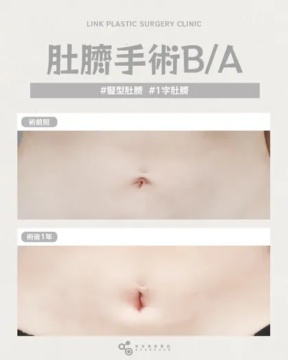 林克整形醫院 | 肚臍術後真實案例分享 ✨🤍手術項目: 肚臍手術🤍前後對比腹部回到該有的平整☺️📢代
