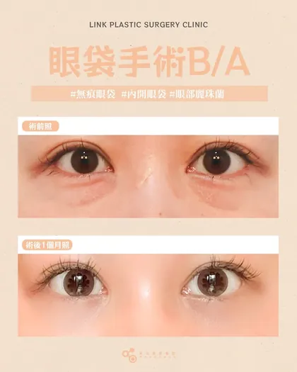 林克整形醫院 | 眼袋術後真實案例分享 ✨🩷手術項目: 眼底脂肪重置🩷眼袋影響的不只是外觀改善後，精