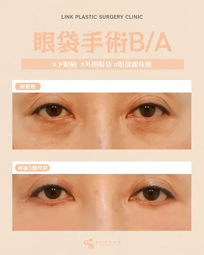 林克整形醫院 | 眼袋術後真實案例分享 ✨🩷手術項目: 下眼瞼手術(外開眼袋)+眼部麗珠蘭🩷外開眼袋