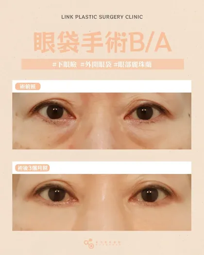 林克整形醫院 | 眼袋術後真實案例分享 ✨🩷手術項目: 下眼瞼手術(外開眼袋)+眼部麗珠蘭🩷找回年輕
