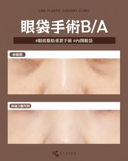 林克整形醫院 | 眼袋術後真實案例分享 ✨🩷手術項目: 眼底脂肪重置(內開眼袋)🩷讓眼下結構回到平衡