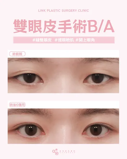林克整形醫院 | 雙眼皮術後真實案例分享 ✨💙手術項目: 縫雙眼皮+提眼瞼肌+開上眼角💙變美不是跟別