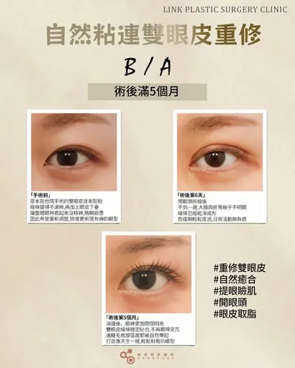林克整形醫院 | 雙眼皮術後恢復過程分享 ✨💙手術項目: 重修縫雙眼皮+提眼瞼肌+開眼頭+眼皮取脂💙