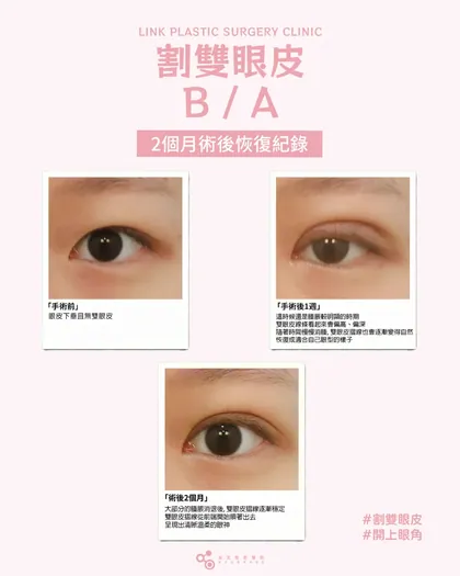林克整形醫院 | 雙眼皮術後恢復過程分享 ✨💙手術項目: 割雙眼皮+提眼瞼肌+開上眼角💙很多人以為，