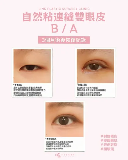 林克整形醫院 | 雙眼皮術後恢復過程分享 ✨💙手術項目: 割雙眼皮+提眼瞼肌+開眼頭+眼皮取脂💙從腫