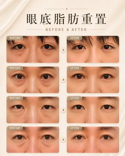 林克整形醫院 | 眼袋術後真實案例分享 ✨🩷手術項目: 眼底脂肪重置🩷好的改變，不是讓別人發現你做了