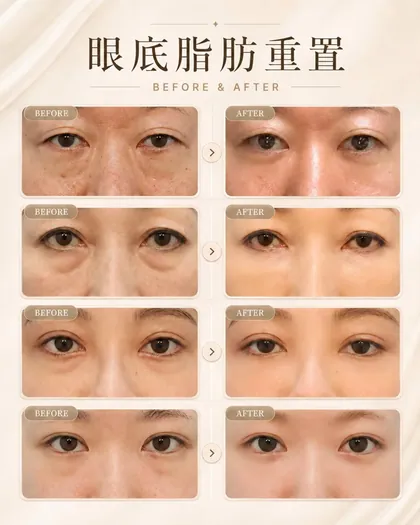 林克整形醫院 | 眼袋術後真實案例分享 ✨🩷手術項目: 眼底脂肪重置🩷👀 看起來累，不一定是真的累眼