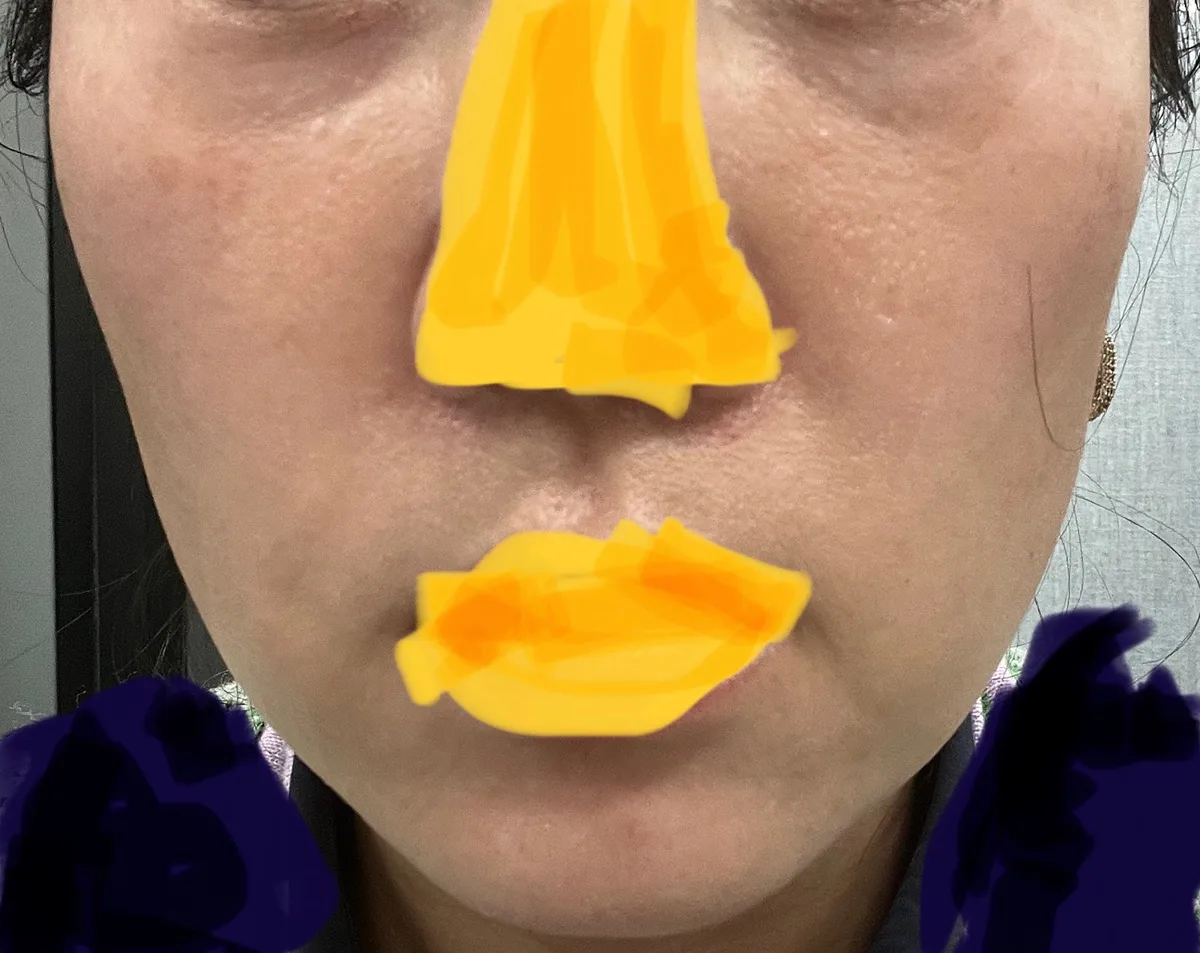 full-face-fat-grafting-korea-real-results-recovery 相關圖片