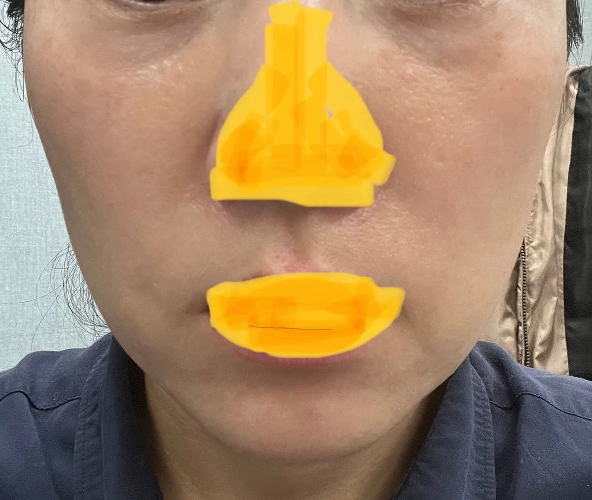 full-face-fat-grafting-korea-real-results-recovery 相關圖片