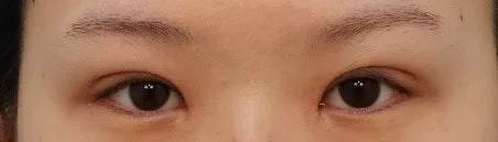 double-eyelid-surgery-korea-real-results-compared 相關圖片