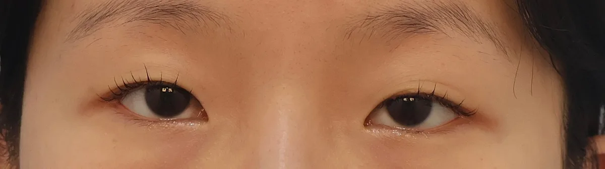 double-eyelid-surgery-korea-real-results-compared 相關圖片