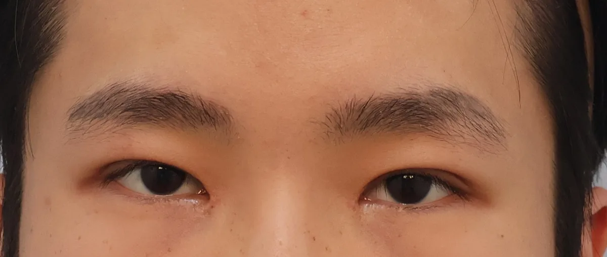double-eyelid-surgery-korea-real-results-compared 相關圖片