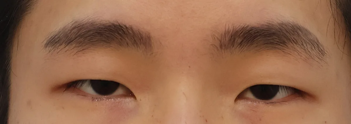 double-eyelid-surgery-korea-real-results-compared 相關圖片