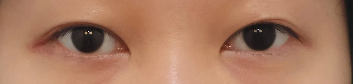 upper-eyelid-fat-removal-korea-real-results 相關圖片