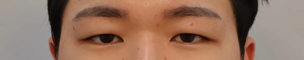 upper-eyelid-fat-removal-korea-real-results 相關圖片