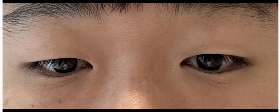 upper-eyelid-fat-removal-korea-real-results 相關圖片